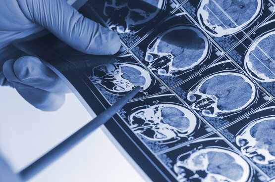 Several MRI images of a human brain