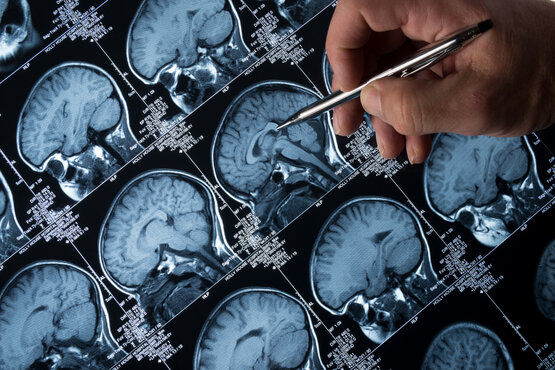 Doctor points with pen to MRI images of the brain with arachnoid cysts
